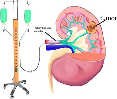 Clinical study of renal artery cold perfusion combined with laparoscopic nephron retention in the treatment of complex renal angiomyolipoma